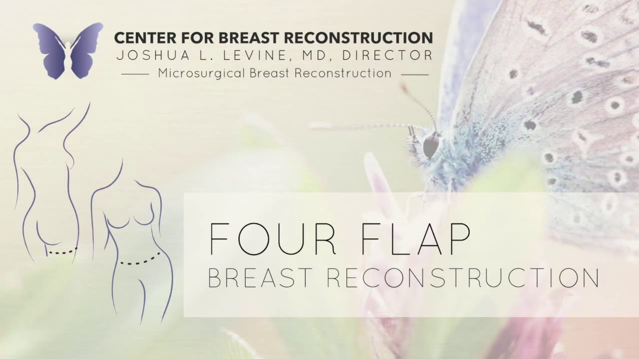 Four Flap Breast Reconstruction - Guided Illustration - By Dr. Joshua L. Levine