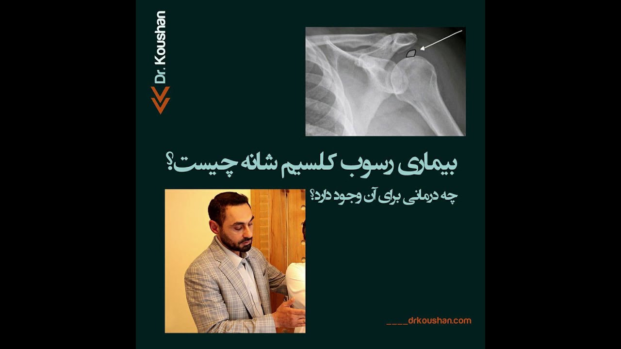 علت رسوب کلسیم شانه چیست؟؟‌ توضیحات دکتر علی کوشان فوق تخصص جراحی شانه
