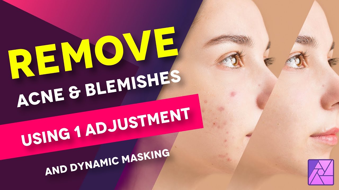 Remove and Clean ACNE, BLEMISHES and SPOTS like a PRO in Affinity Photo