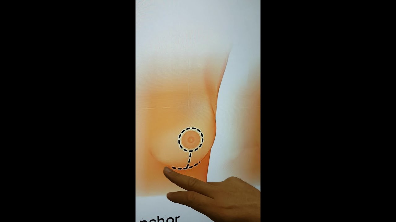شد ورفع الثدي   دكتور امير