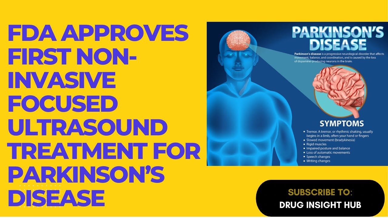 FDA Approves First Non Invasive Focused Ultrasound Treatment for Parkinson’s Disease