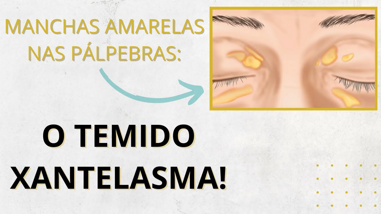 Manchas amarelas nas pálpebras! Xantelasma : o que é e como tratar?