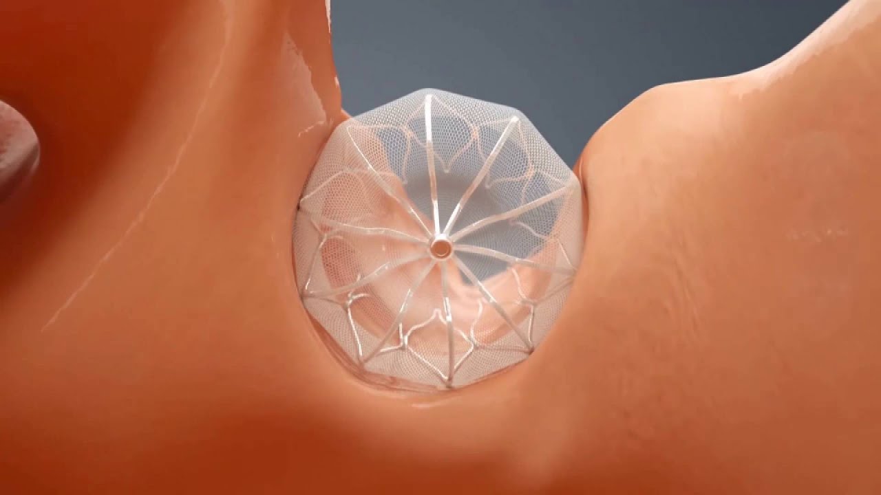 Left Atrial Appendage Closure (feat. Dr. Almany)