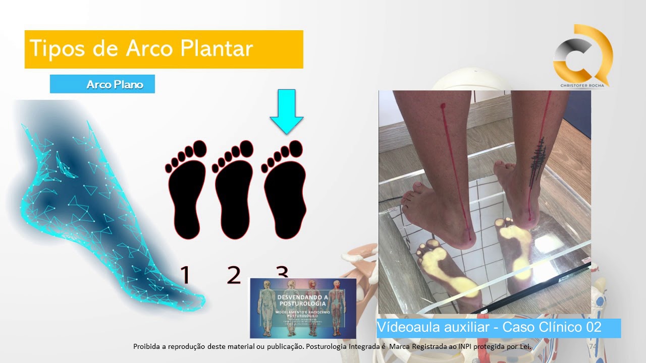 Arco plantar (Tipo de P&eacute;)