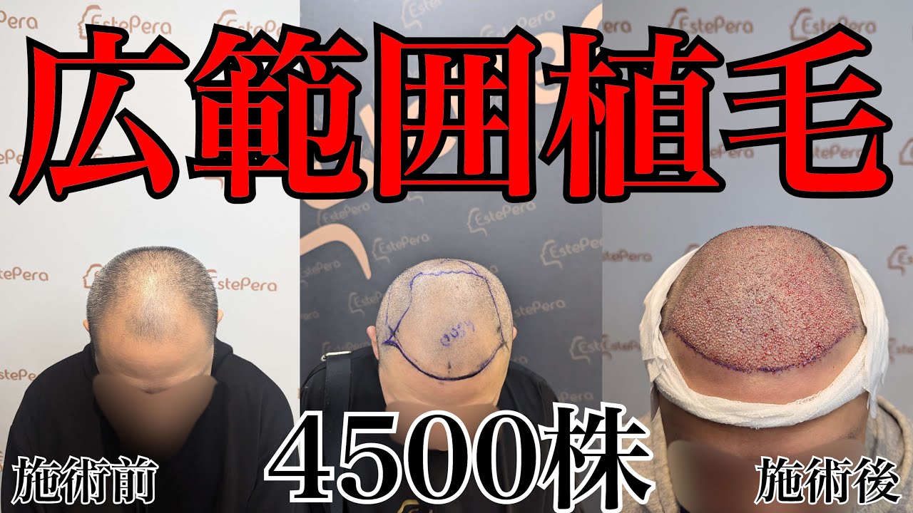【広範囲薄毛】悩みに悩んでたどり着いた植毛！決心して施術を受けた感想を聞いたら意外な返答が、、、！？【トルコ植毛】