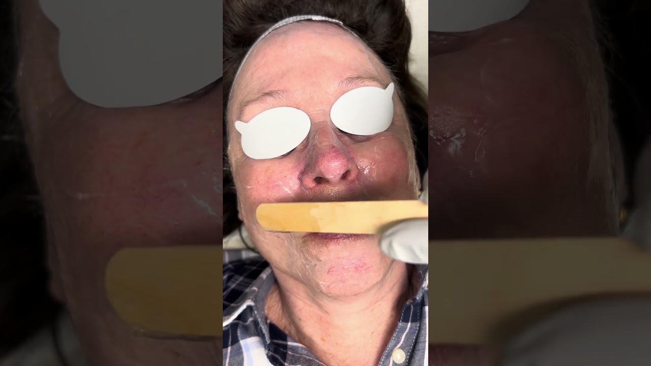 IPL Treatment From Start To Finish | Spectrum Dermatology of Atlanta | Alpharetta, Roswell, Cumming