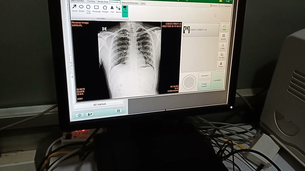 Chest X-ray PA View kaise Film Banaye #chestxray #xray #radiology