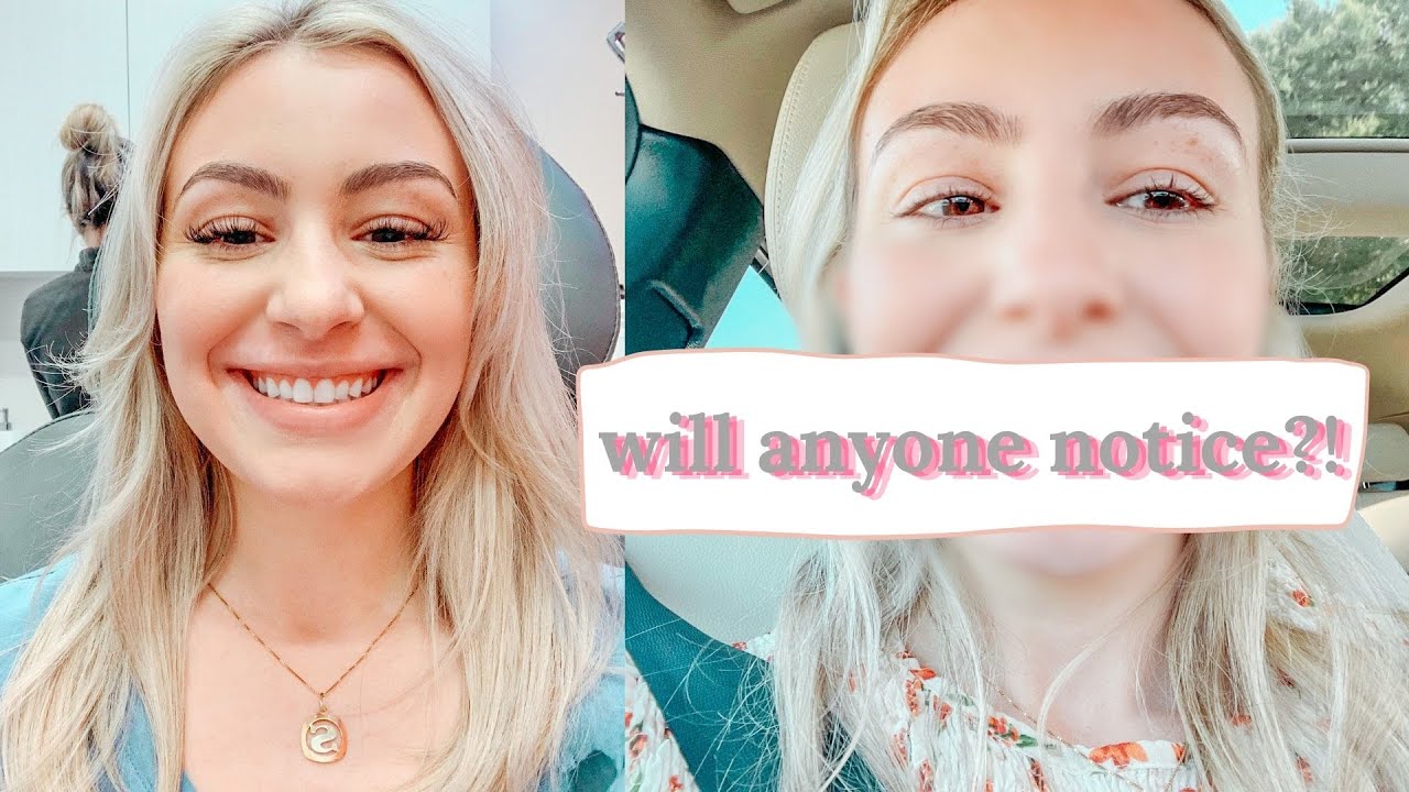 I got a LIP FLIP... And told no one. (before & after)