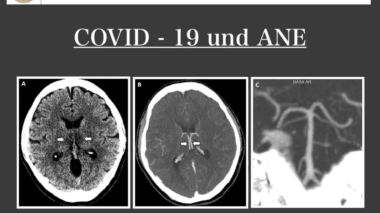COVID-19 I Was macht das Coronavirus mit unserem Gehirn - Ein seltener Fall I ANE I Brain & Synapse