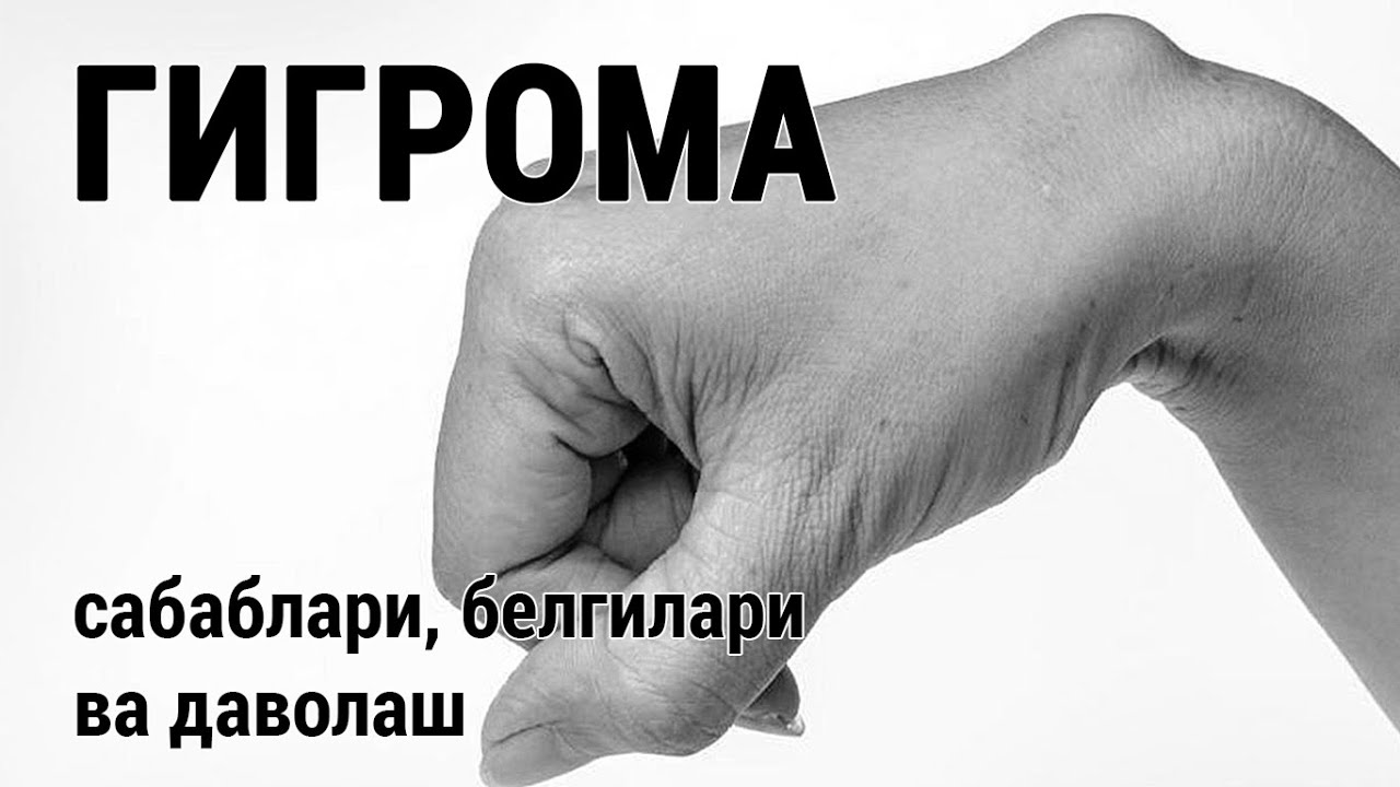 Гигрома. Сабаблари, белгилари ва даволаш.