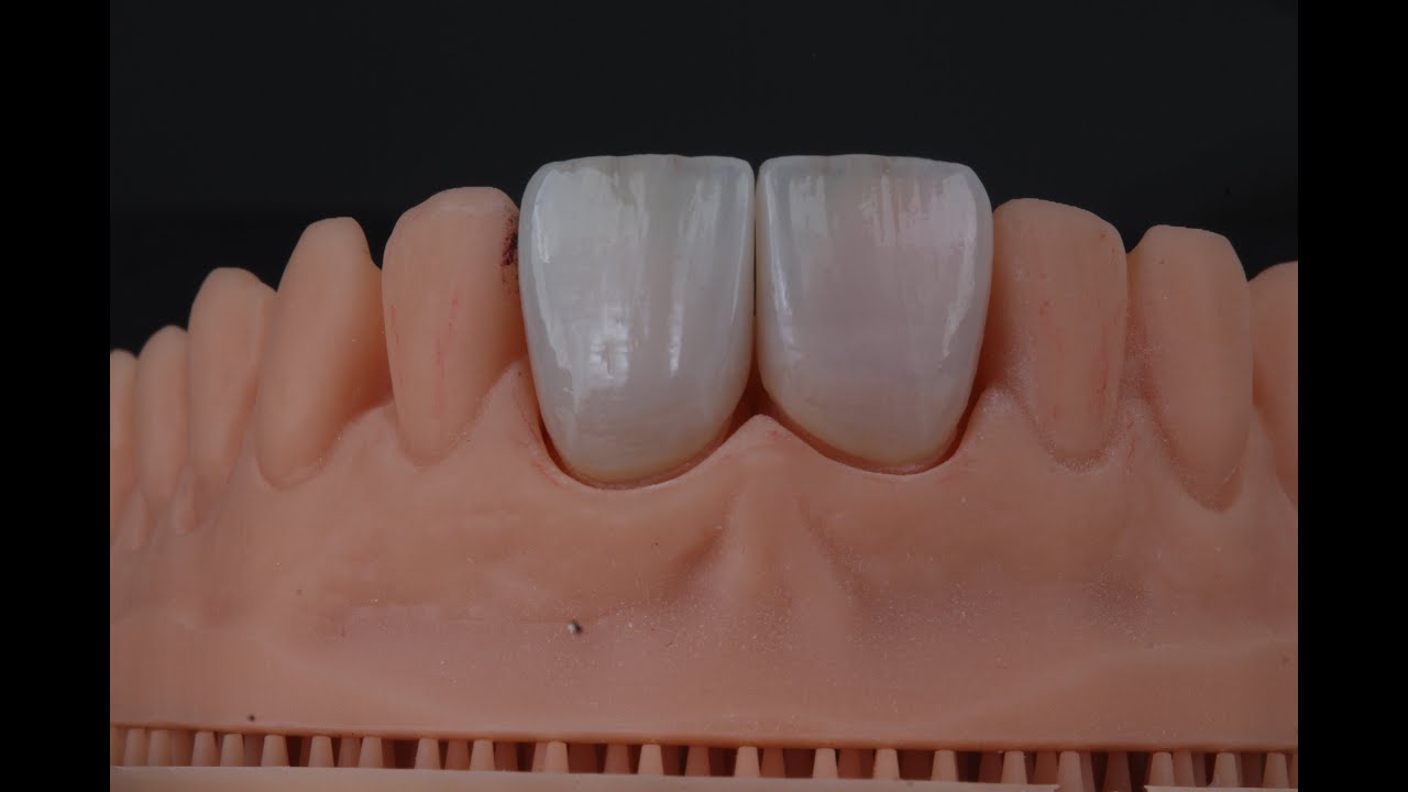 Cimentação  de facetas cerâmicas com isolamento absoluto