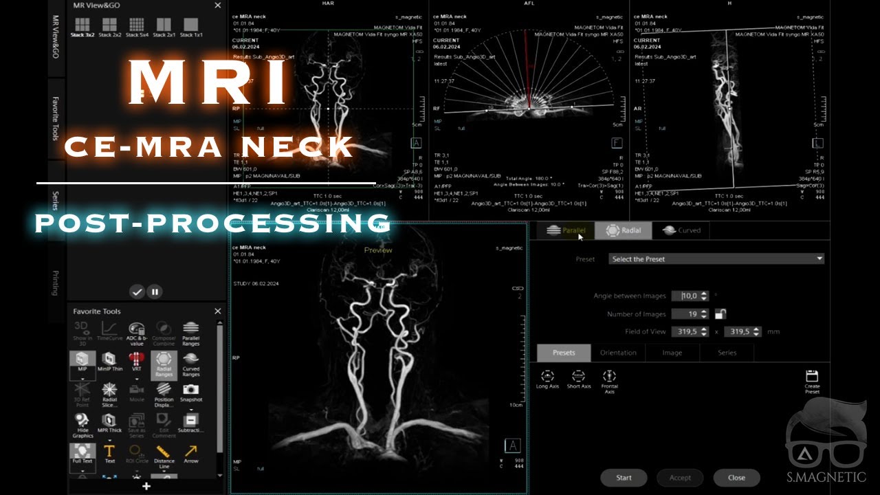 MRI – CE-MRA NECK & POST-PROCESSING