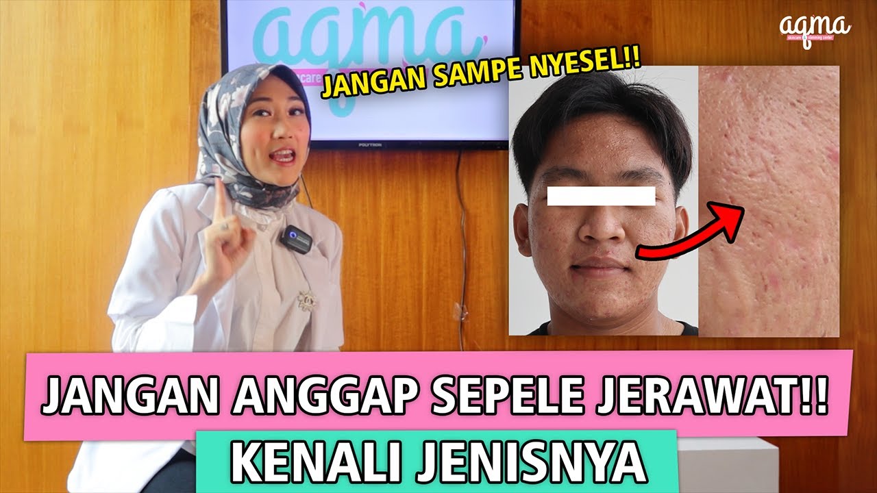 INI DIA TIPS MENGHILANG JERAWAT SERTA TIPE-TIPE JERAWAT | TANYA DOKTER AQMARINA