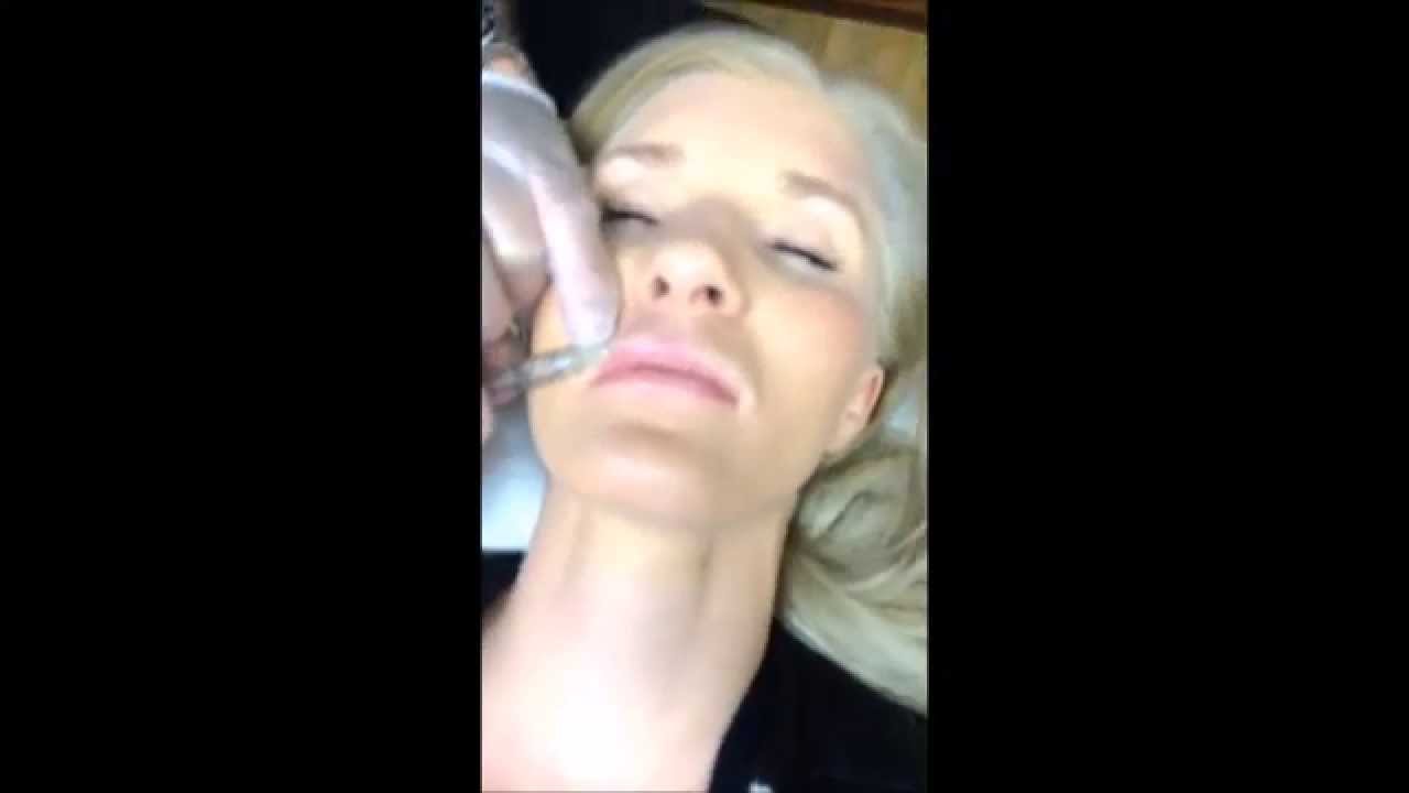 Newport Beach MedSpa Dermal Filler