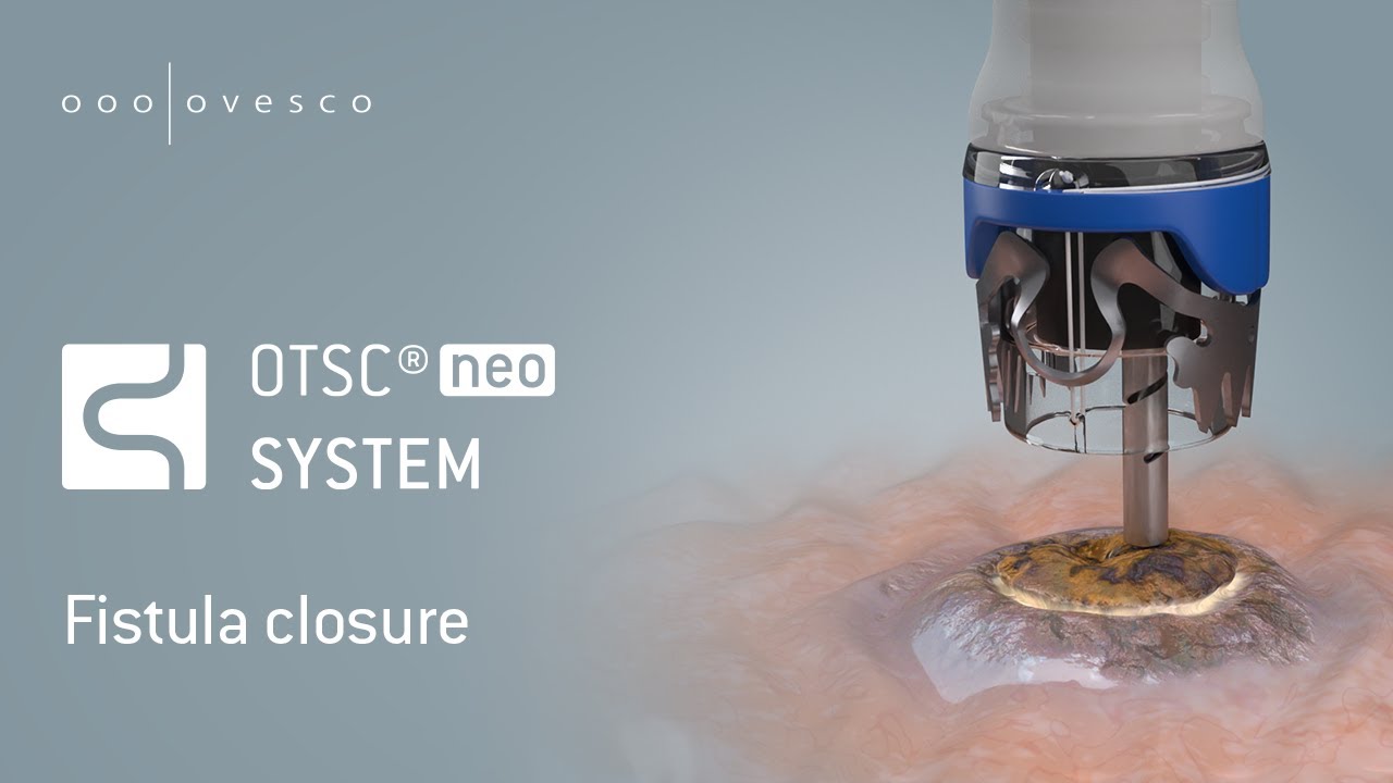 OTSC&reg;neo | Fistula closure