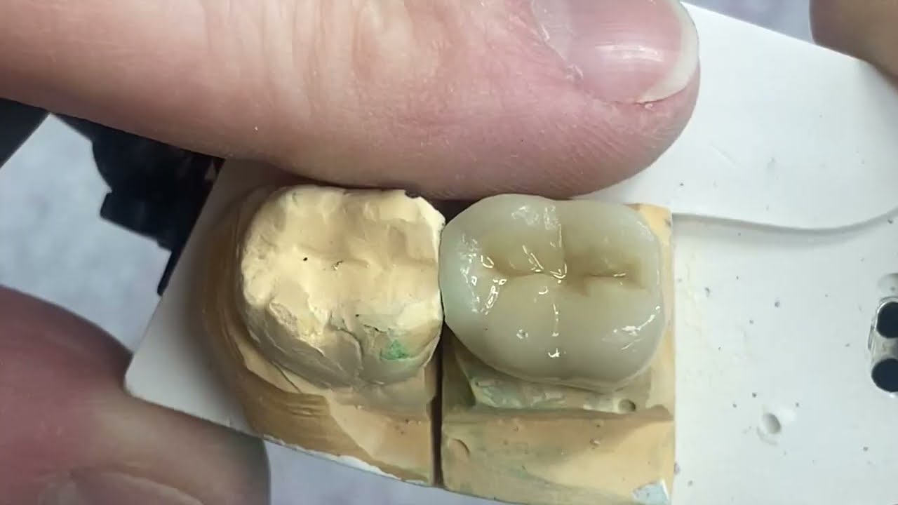 How to Add Contact to Porcelain Crown