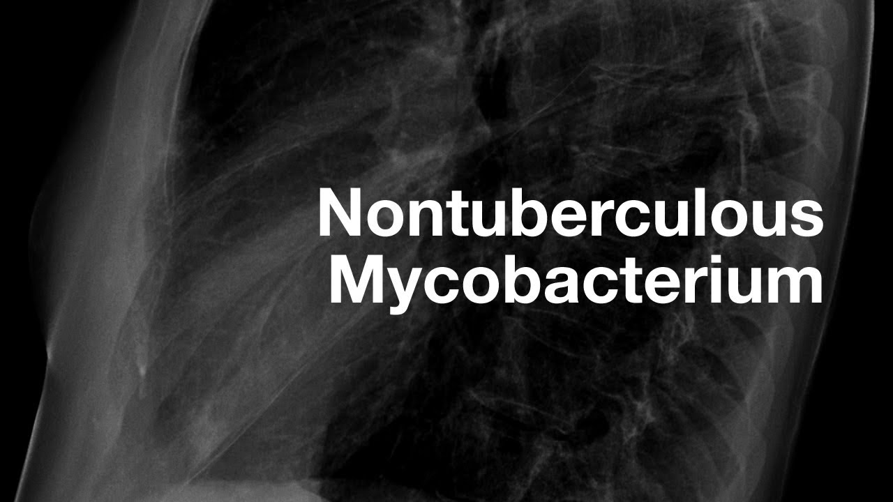 Radiology of Nontuberculous Mycobacterium