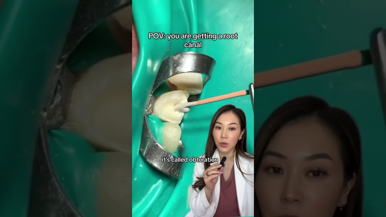 Getting a root canal on a front tooth. #rootcanal #cavity #dentist #dentalwork