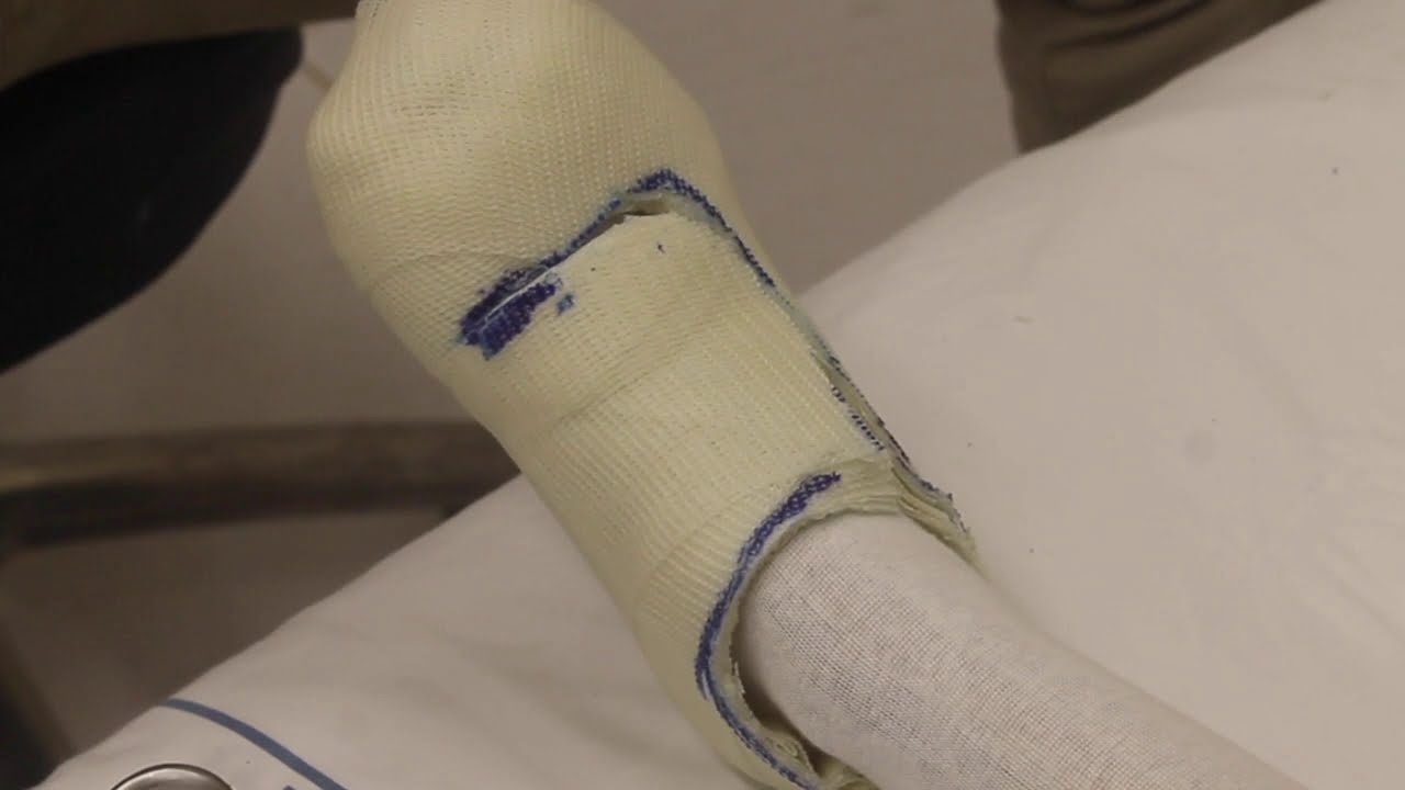 Total contact cast shoe