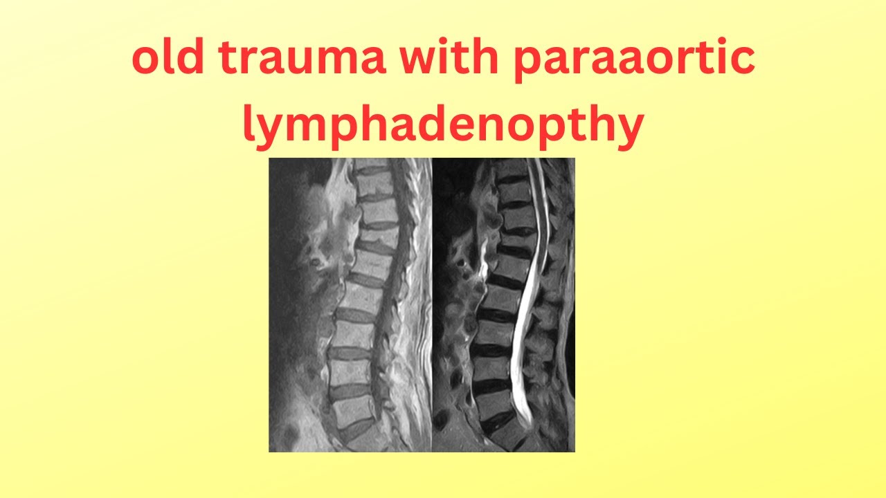 Old compression fracture with paraaortic lymphadenopathy