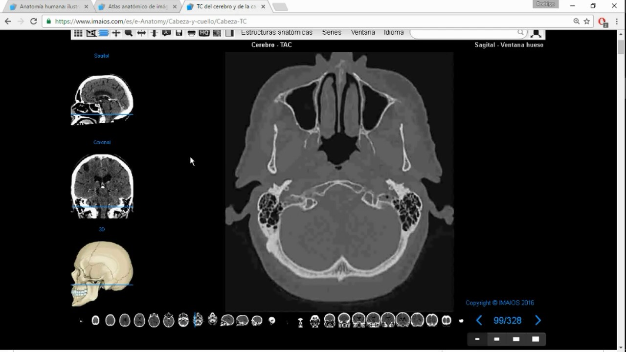 Tomografía Computada de Cabeza para Anatomía Parte 1