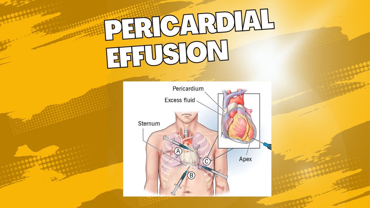 Overview of Pericardial Effusion