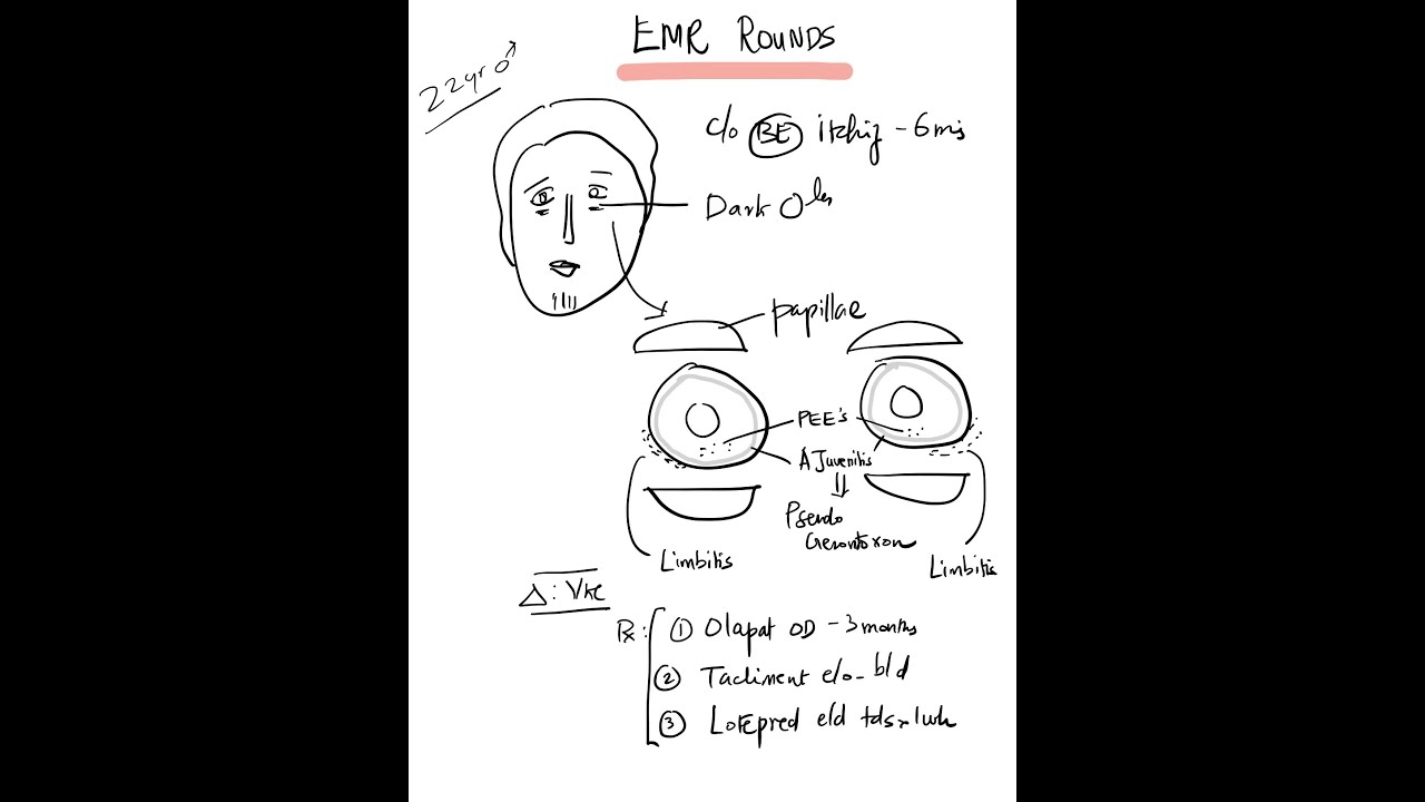 Case 5: Vernal Kerato Conjunctivitis (VKC) - Pharmacotherapy