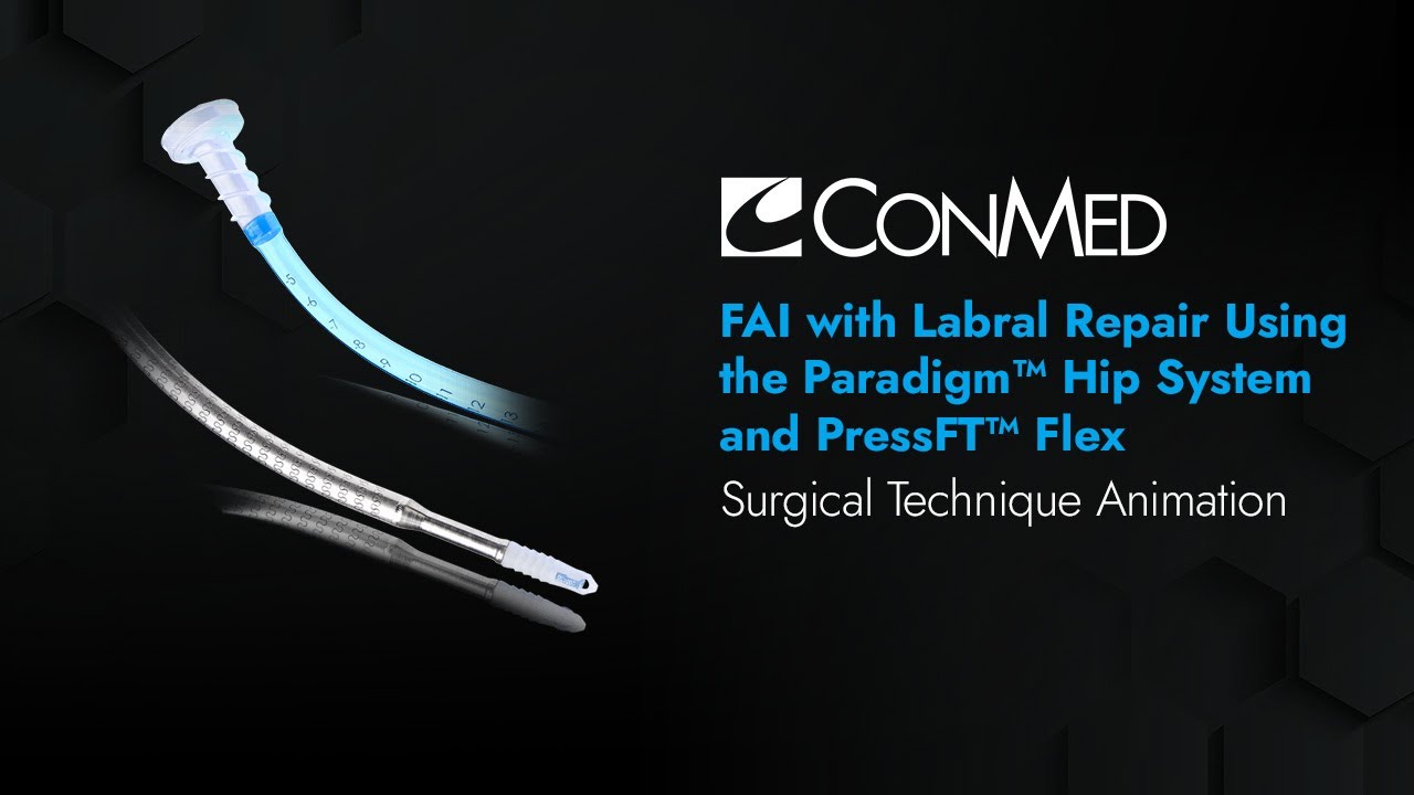 FAI and Labral Repair Using the Paradigm™ Hip System and PressFT™ Flex Anchor - CONMED Animation
