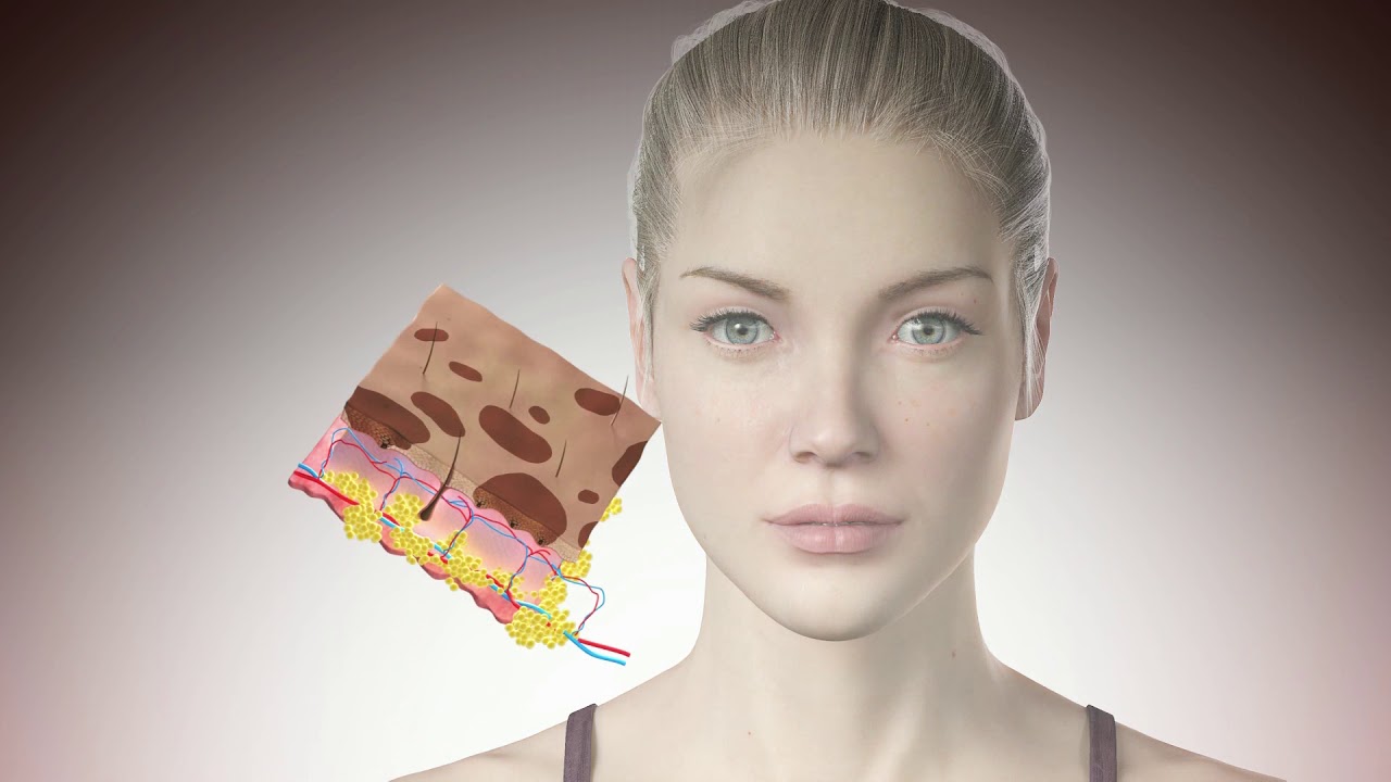 Lutronic Clarity Laser — длинноимпульсный александритовый лазер с длиной волны 755 нм и неодимовы...