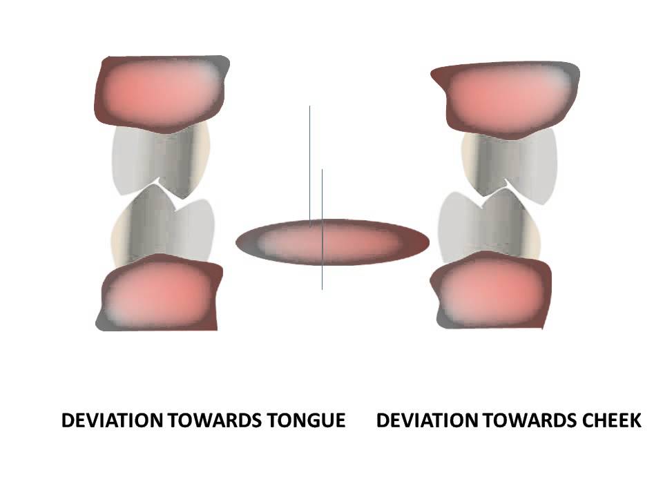 Introduction to equilibration- Occlusal interferences