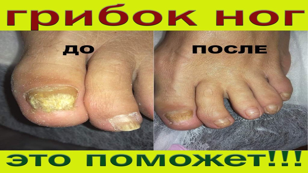 Лучшее средство от грибка ногтей и стоп. Полная схема лечения