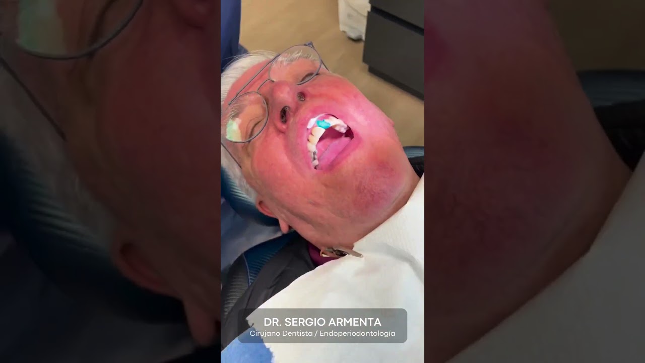 Descubre c&oacute;mo recuperar tu sonrisa con carillas de cer&aacute;mica. ✨🤓 #sonrisaperfecta #carillas