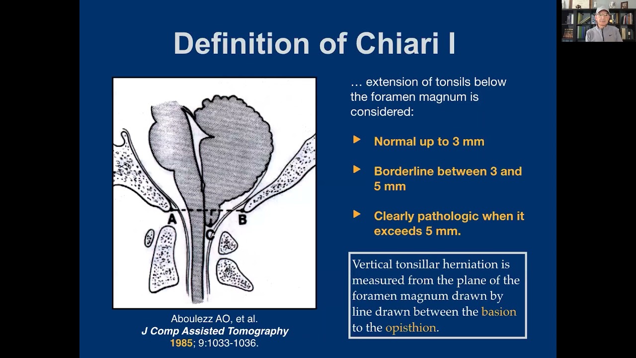 Chiari & Exercise Roundtable Part 1