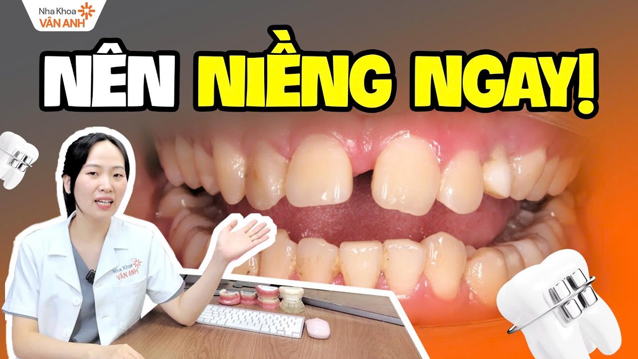 Răng Thưa: Khi Nào Nên Niềng? Đừng Niềng Khi Chưa Biết 2 Trường Hợp Chống Chỉ Định