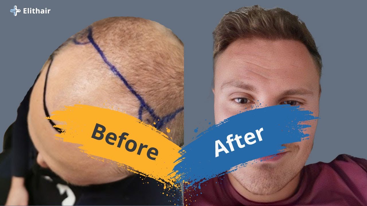 Hair Transplant Before and After - Month by Month results Elithair