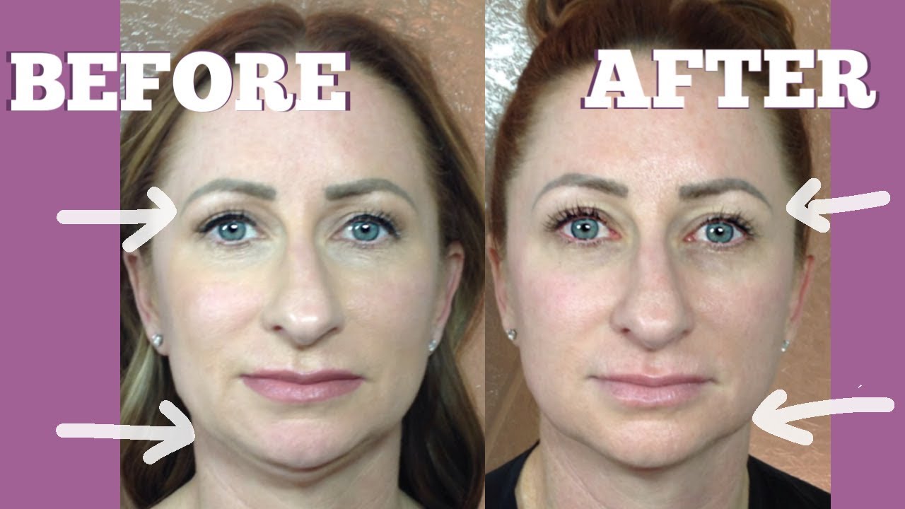 How I Got Rid Of My Double Chin WITHOUT Injections Over 40