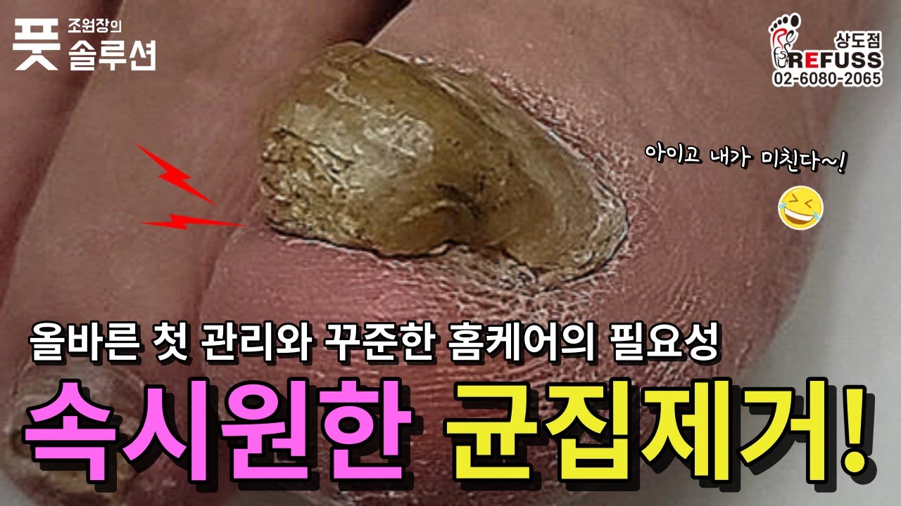 따님 추천으로 방문하신 어머님의 조갑구만 발톱! 속시원한 발톱제거와 꼼꼼한 관리방법 안내해드렸어요~ ^^ #조원장의풋솔루션 #레푸스상도점 #문제성발관리 #refuss #서울레푸스