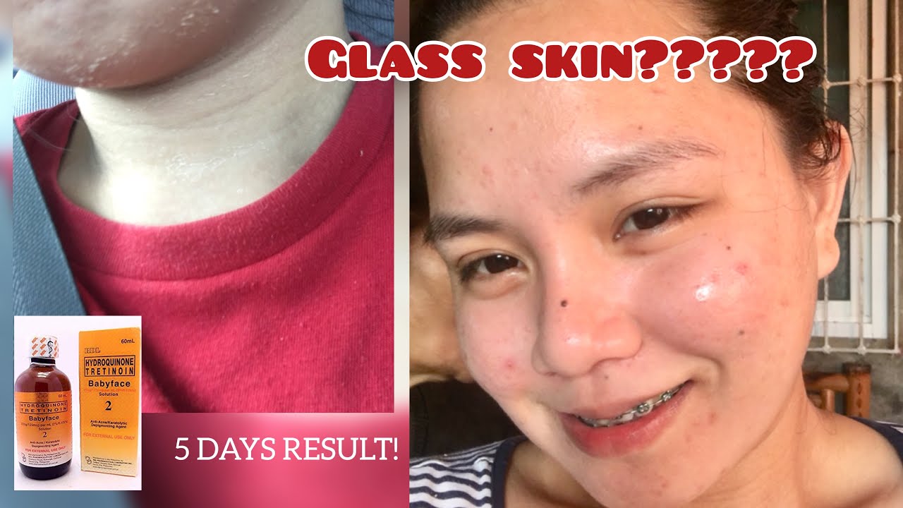 RDL BABYFACE SOLUTION #2 | NAKAKA GLASS SKIN??? | 5 DAYS RESULT