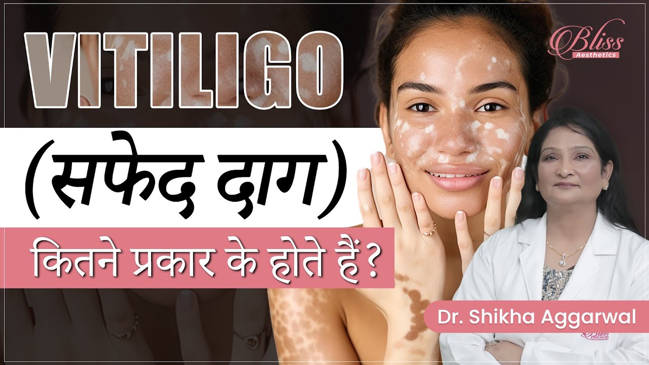 Vitiligo  Skin Disease | Vitiligo Treatment | Types of Vitiligo | Skin Specialist in Ludhiana