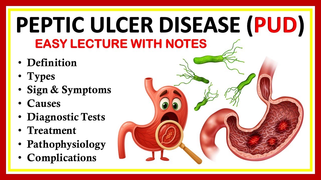 Peptic Ulcer Disease (PUD), Definition, Types, Sign & Symptoms, Causes, Diagnostic Tests, Treatment.