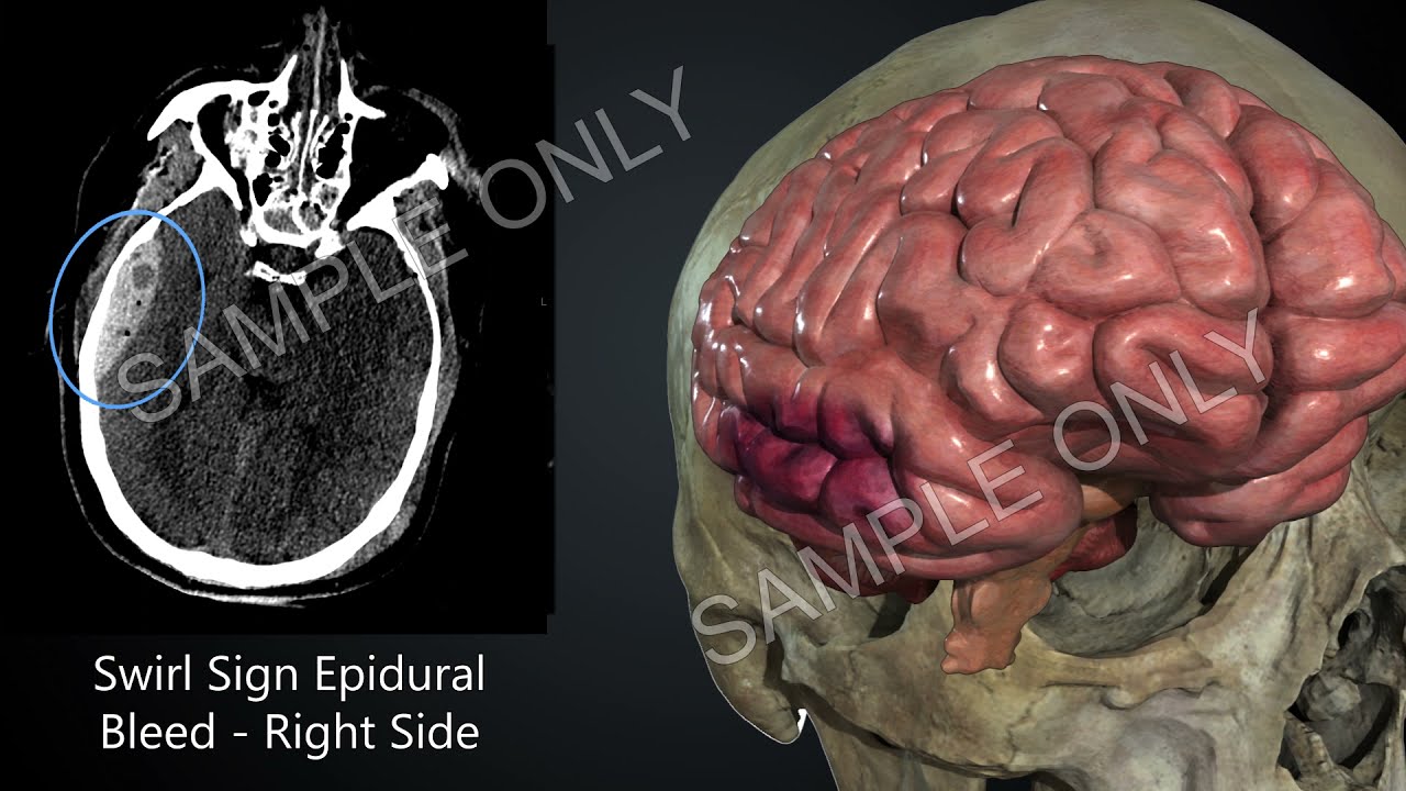 Car Crash Forensic Animation - Forces Experienced by Brain