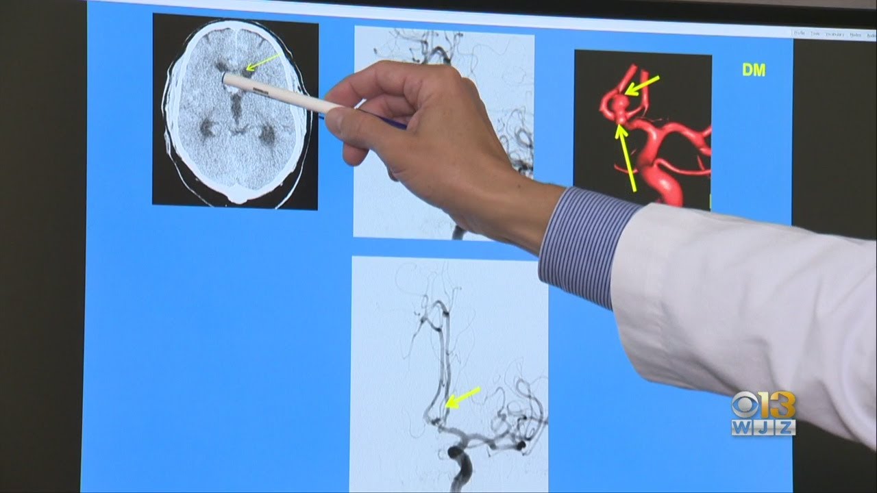 Strokes At An Early-Age Are More Common Than You May Think
