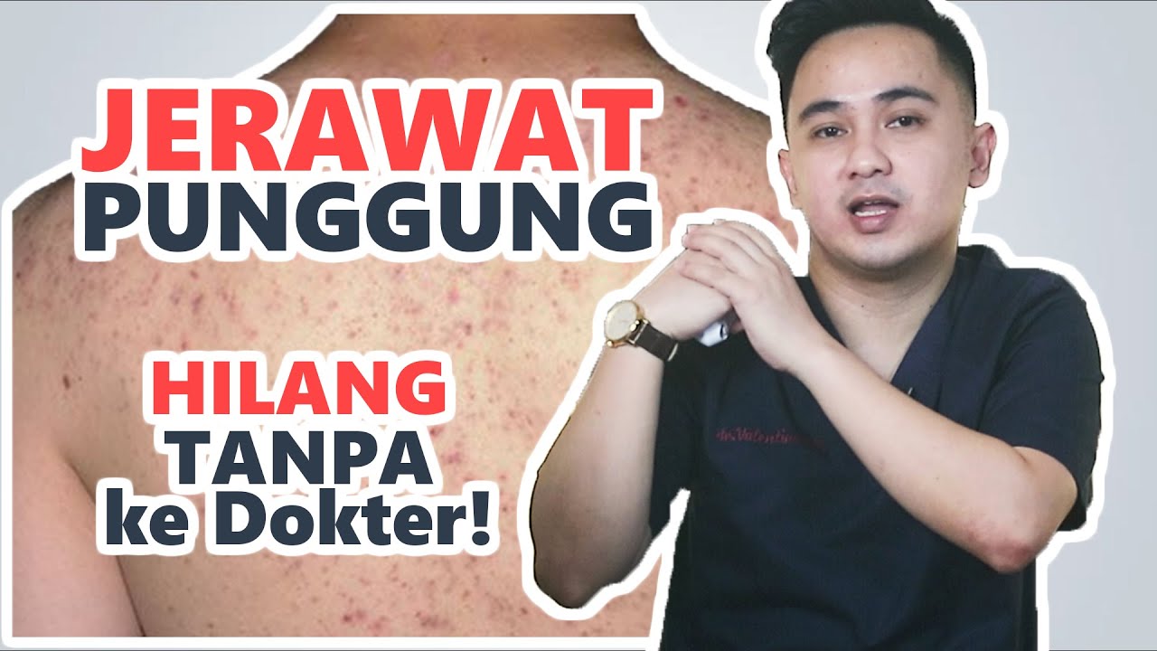 Cara menghilangkan JERAWAT PUNGGUNG sendiri di rumah. Ampuh!