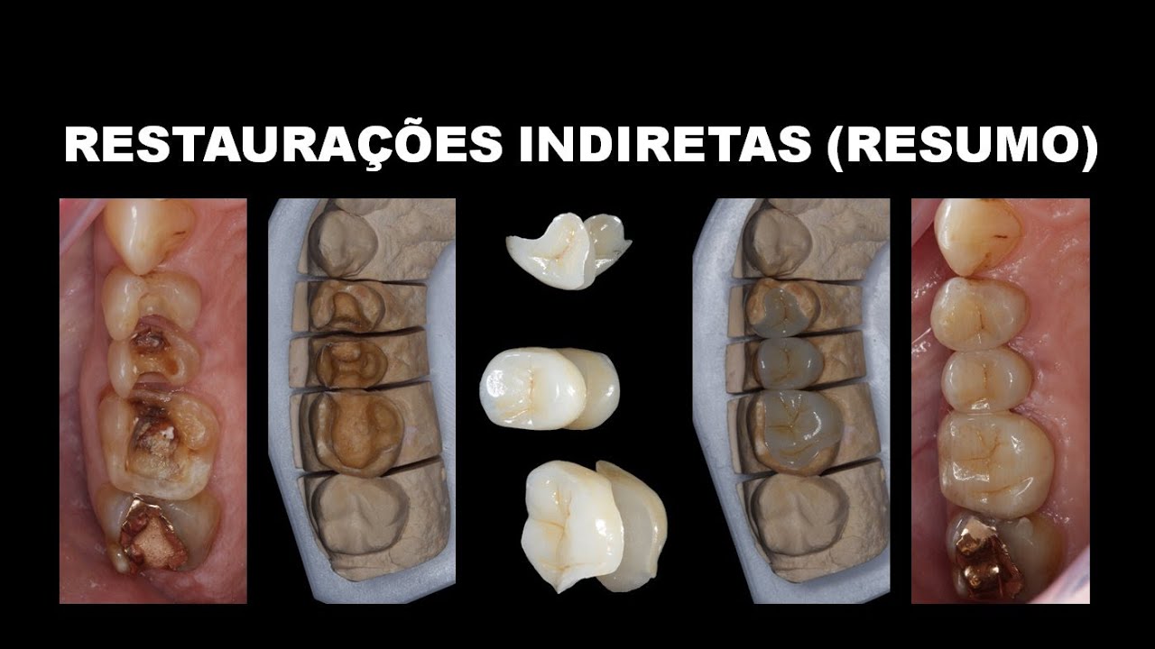 RESTAURAÇÕES INDIRETAS (RESUMO)