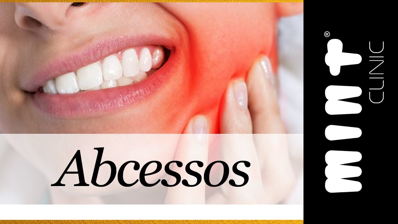 Abcessos Dentários - Clínica Mint