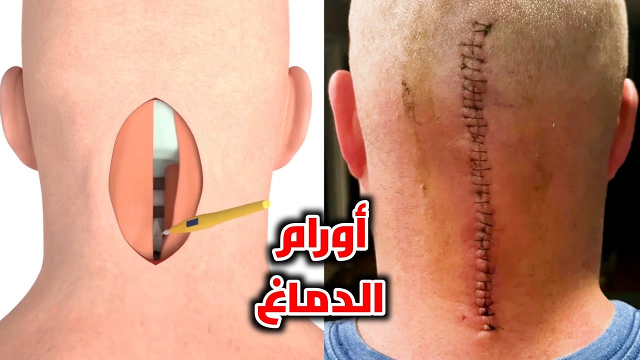 شاهد عملية ازالة ورم من الدماغ _ brain tumor surgery