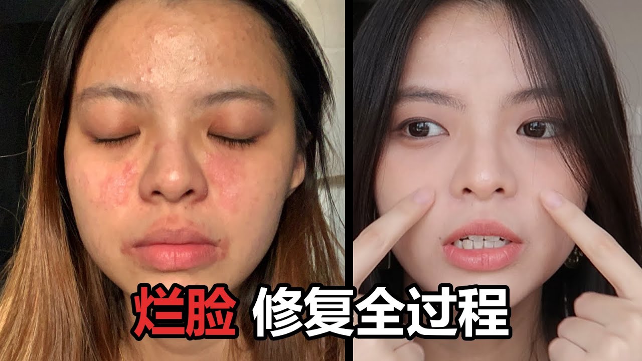 😭敏感大爆发 | 一个月时间修复，神物推荐，维持好肌肤的习惯，理肤泉B5修复霜