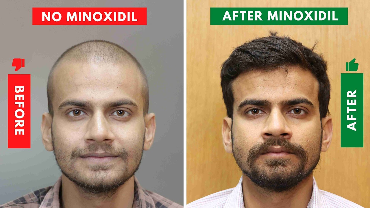 3 Tips - How to Get Best Minoxidil Hair Regrowth Results |Hair Loss Treatment in Androgenic Alopecia