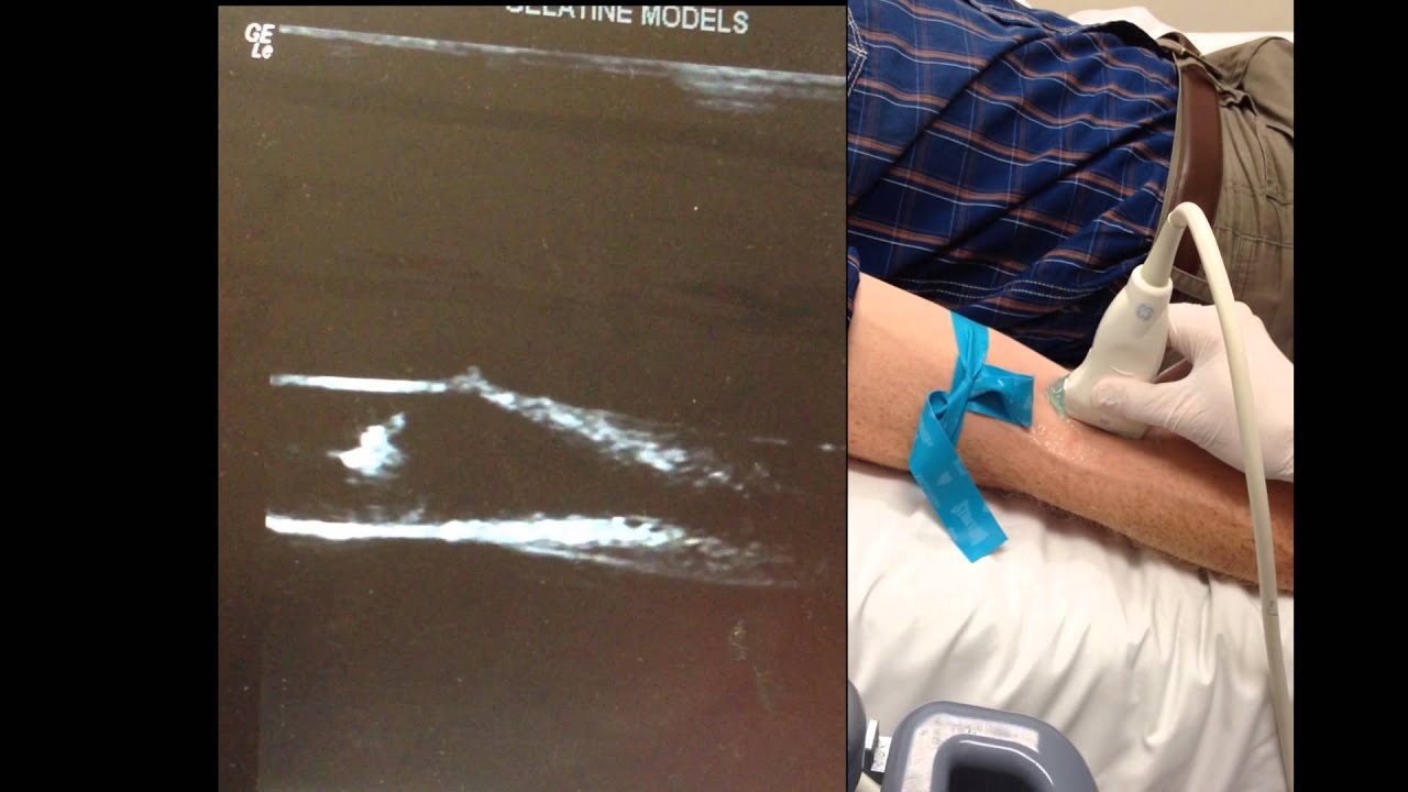 ULTRASOUND GUIDED CANNULATION