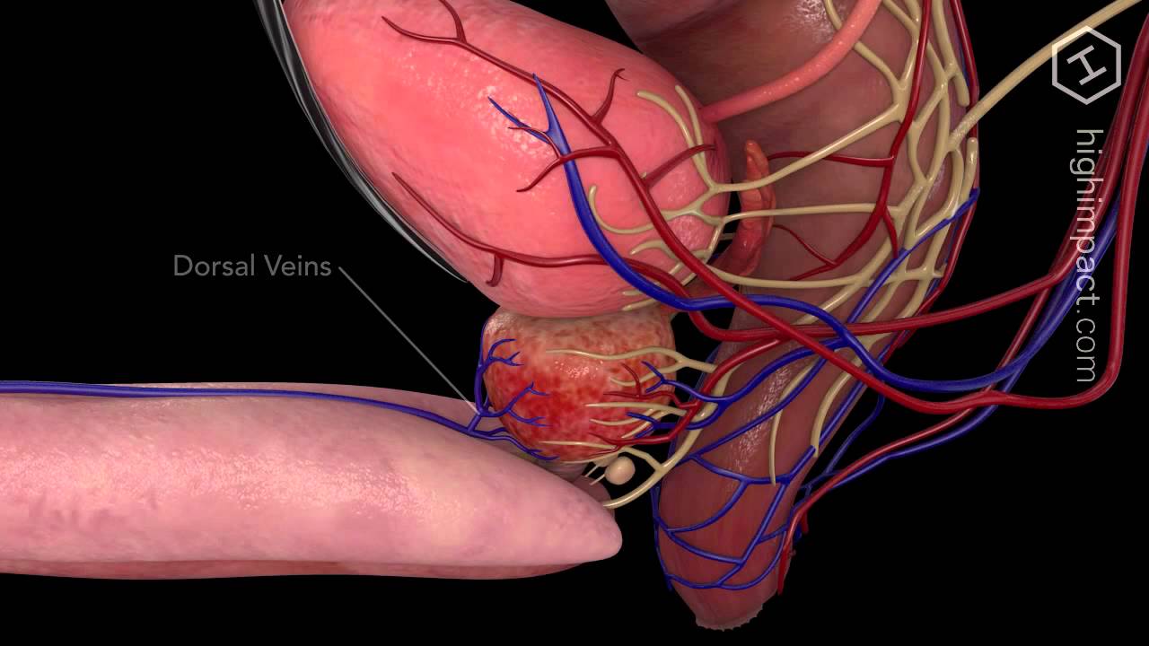 Open Prostatectomy